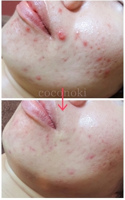pageニキビ組み写真2