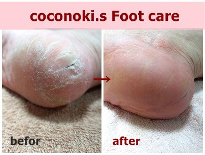 フットマッサージ　角質ケア